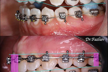 Функционально-эстетический оптимум  ортодонтического лечения