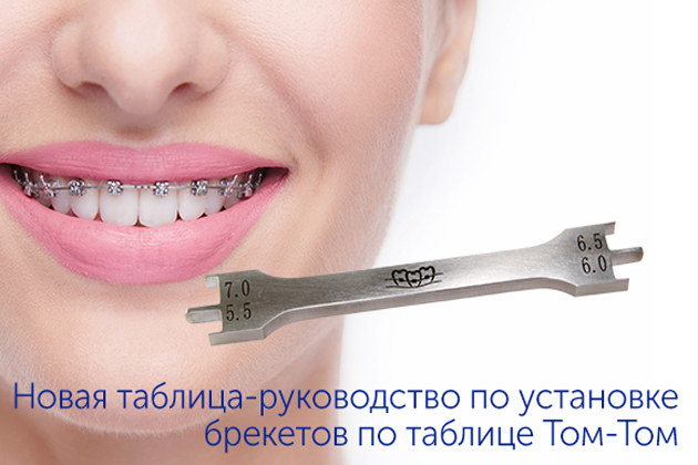 Таблица-руководство по установке брекетов Таблица-руководство по установке брекетов