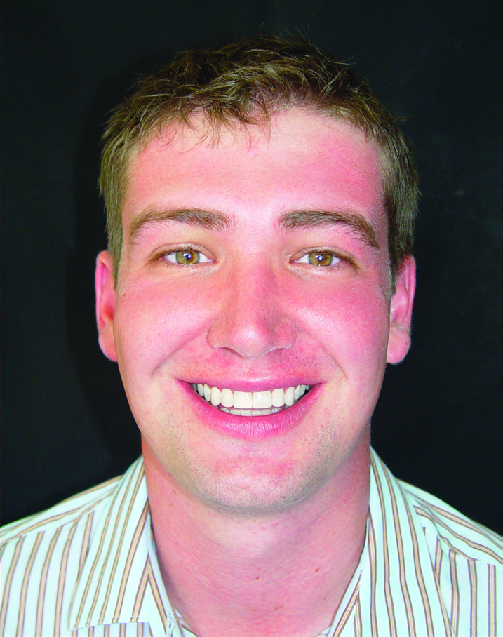 Результат лечения брекетами MBT