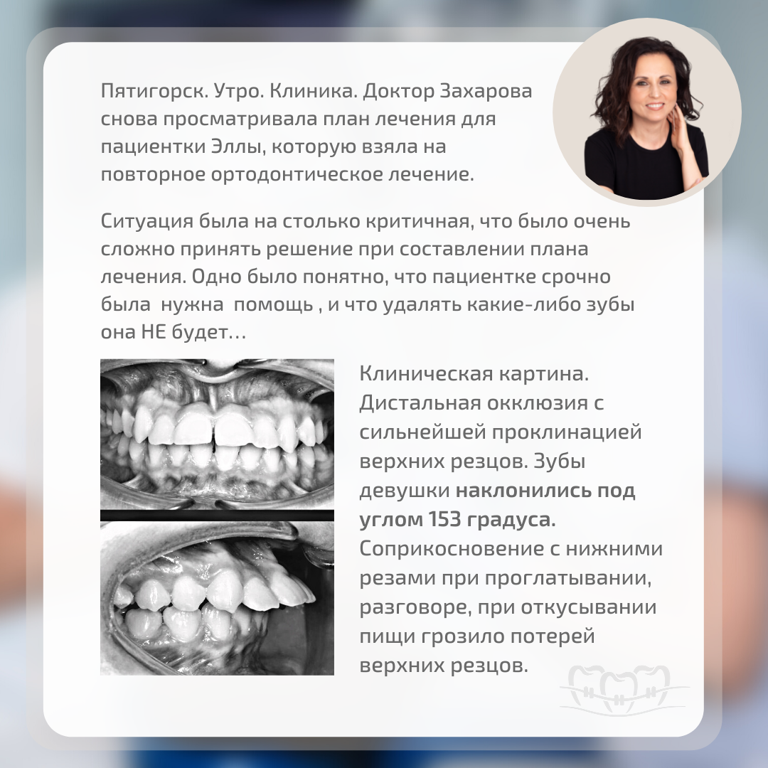 Клинический кейс, в котором удалось спасти передние зубы пациентке  с дистальной окклюзией и сильнейшей проклинацией верхних резцов. 